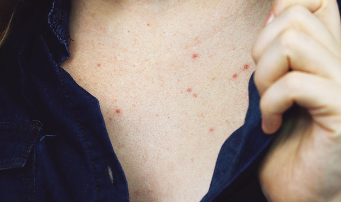 How to get rid of chest acne