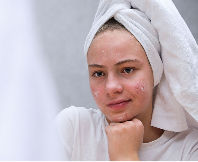 10 things to try when acne won’t clear