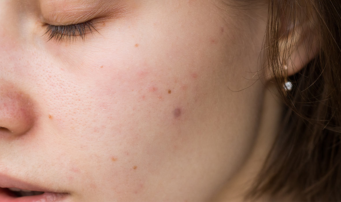 Why do pimples pop up in clusters?