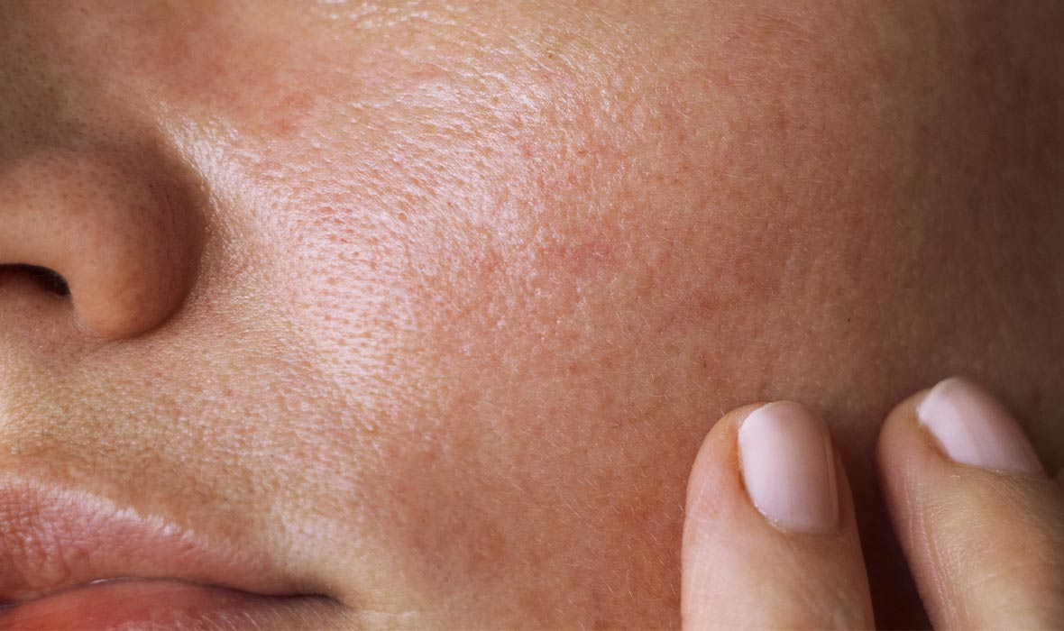 What causes oily skin?