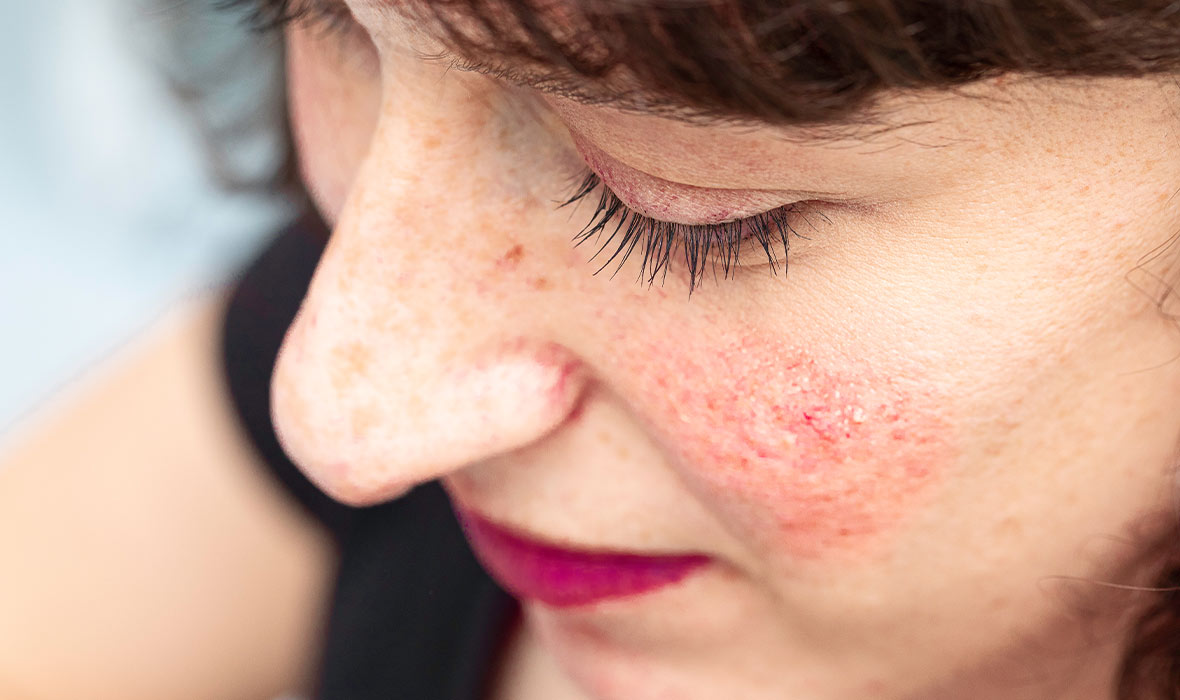 Rosacea and Acne