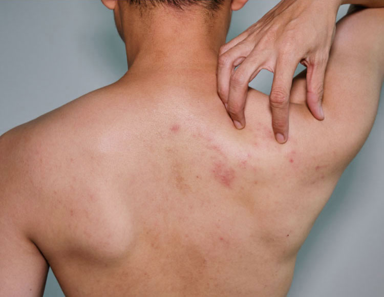 Tips for Preventing and Getting Rid of Shoulder Acne