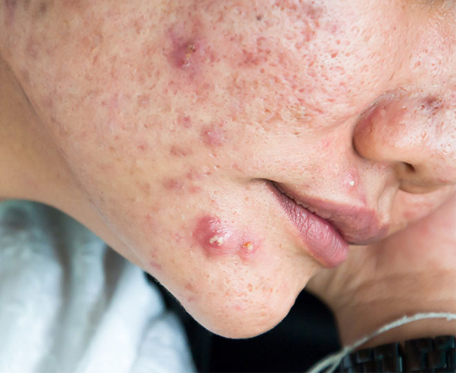 nodular acne vs cystic acne