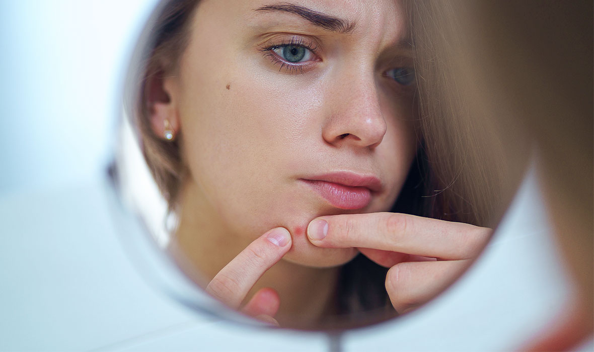 How Long Do Pimples Last?