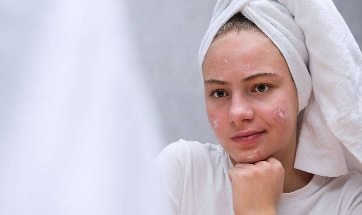10 things to try when acne won’t clear