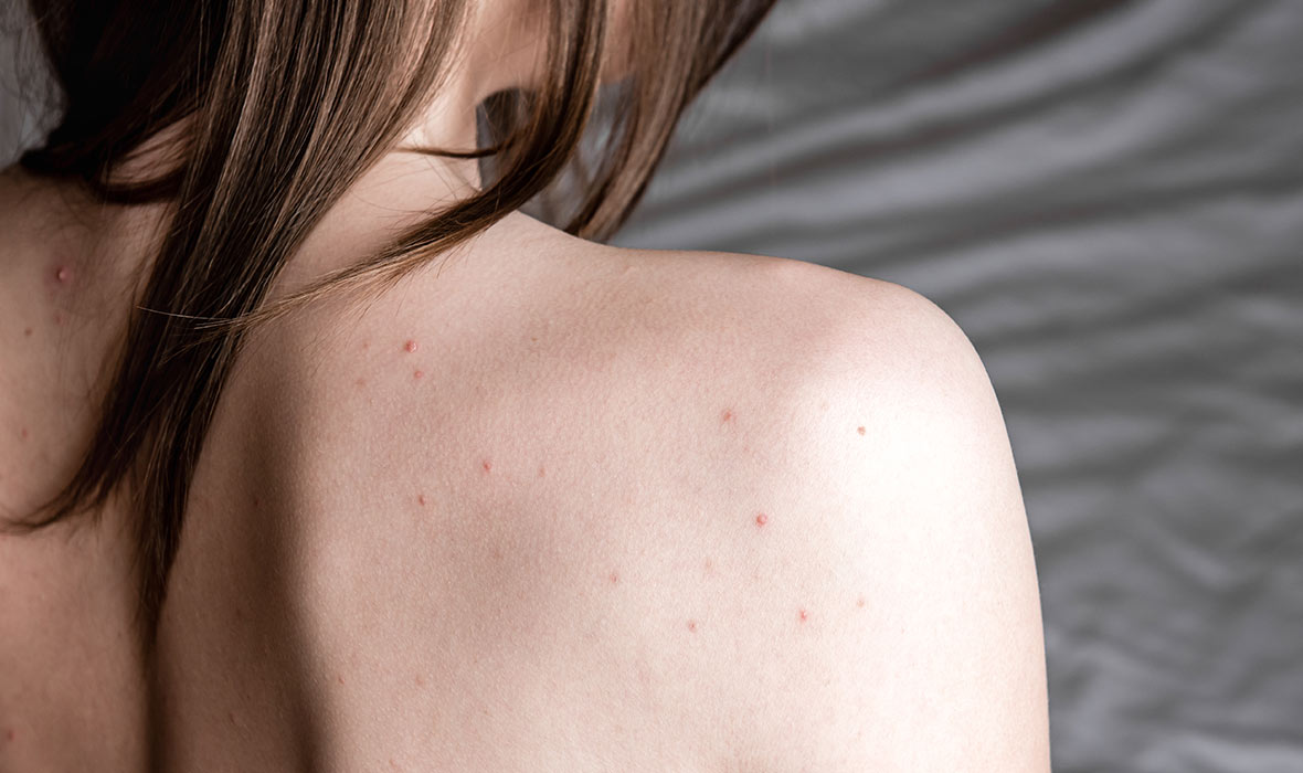 Easy tips for preventing and getting rid of shoulder acne