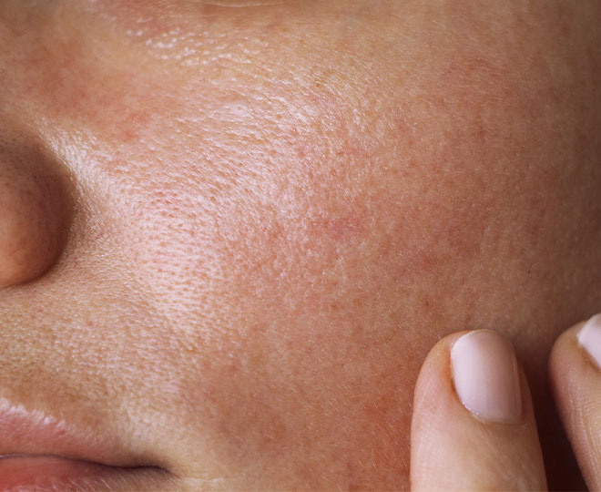 What Causes Oily Skin? | Proactiv®