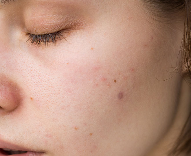 Why do pimples pop up in clusters?