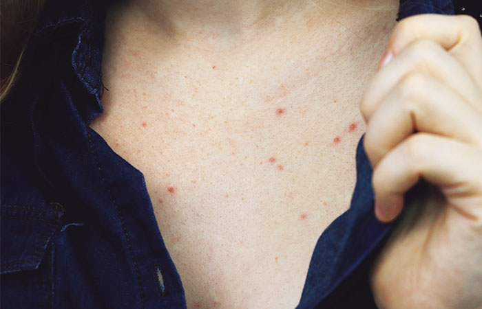 treating-body-acne