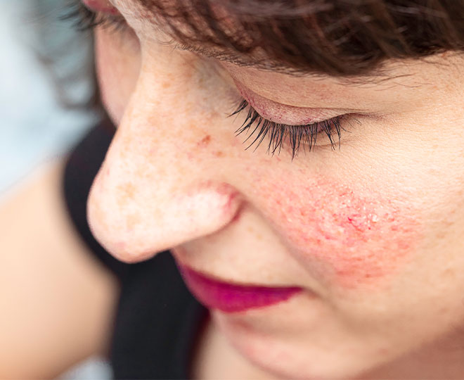 Rosacea and Acne