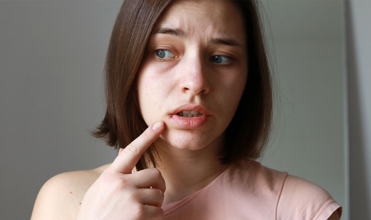 How to get rid of a pimple on your lip