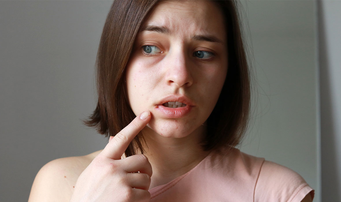 how to get rid of pimple on lip line