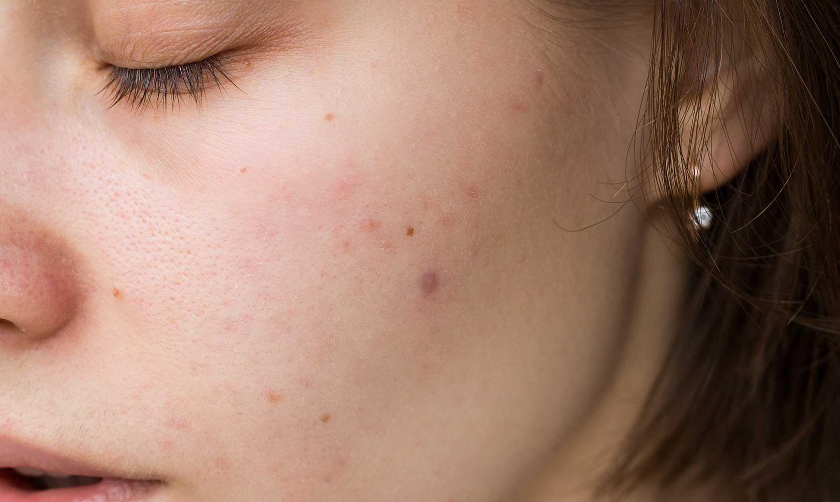 why-do-pimples-pop-up-in-clusters-proactiv