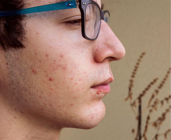 Stages of acne and how to get rid of it Proactiv® Resource Hub