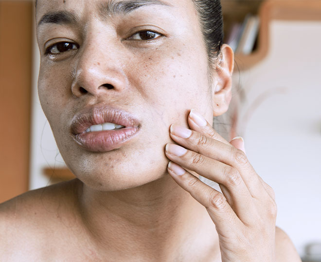 dry peeling skin on face
