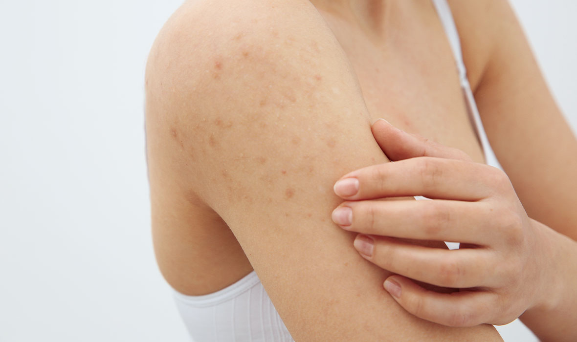 Arm Acne & How to Get Rid of it