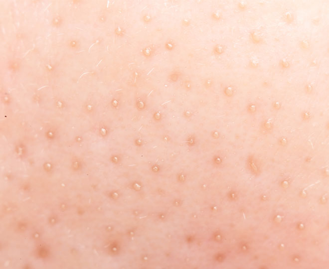 Blackheads vs. sebaceous filaments