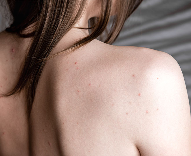 How to Get Rid of Shoulder Acne: Quick and Easy Tips