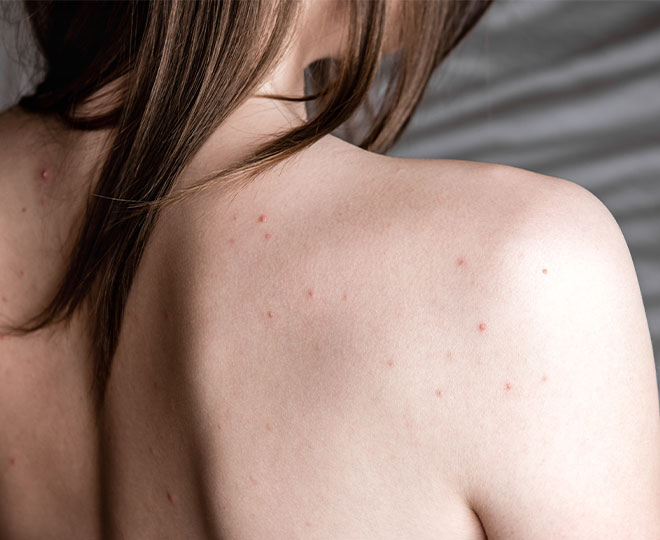 Here's Why Back and Chest Acne is So Common & How to Treat It