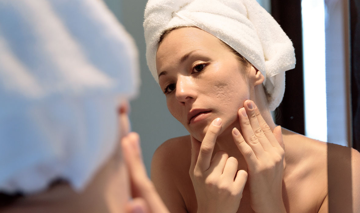 How to treat and prevent acne scars