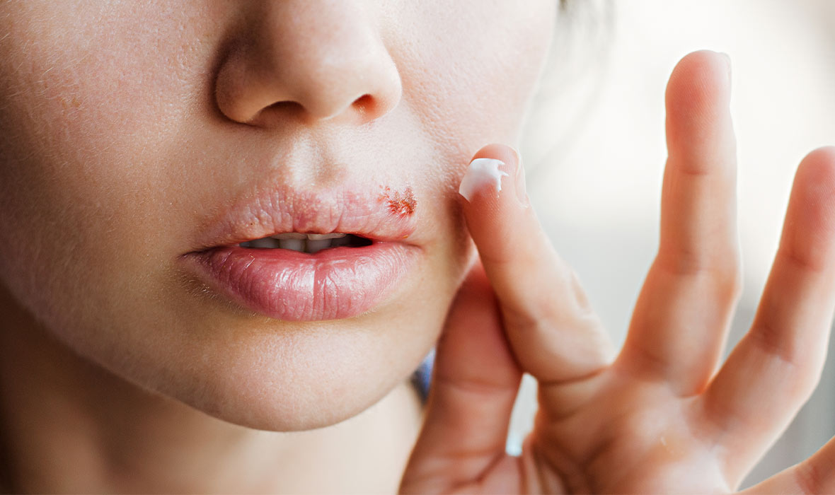 How to get rid of pimple scabs