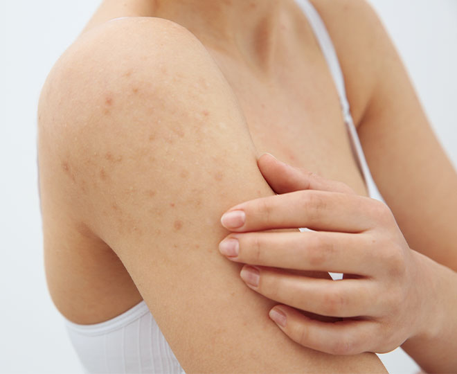 Acne on your arms: Causes, prevention and treatment