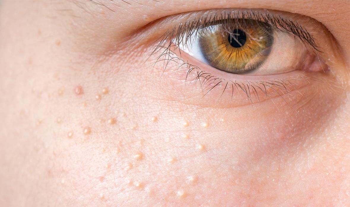 What are those tiny bumps on your face?