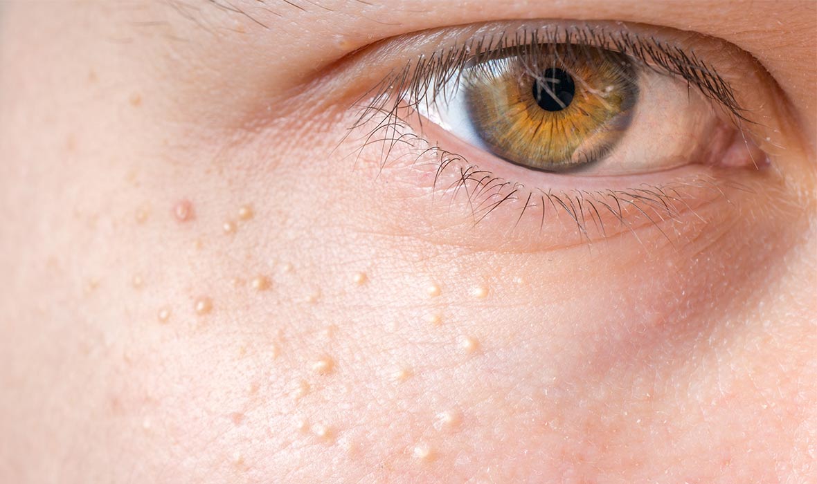 what-are-those-tiny-bumps-on-your-face-5-possibilities