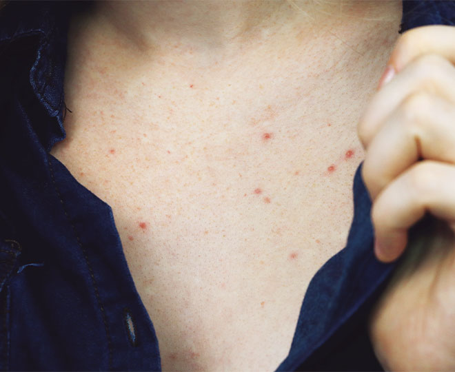 What Causes Chest Acne And How To Get Rid Of It